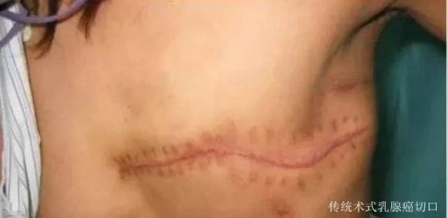 乳腺癌手术后刀疤图片图片