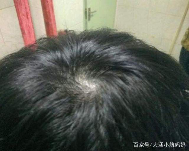 头旋正常发量图片,头发稀疏度图_文秘苑图库