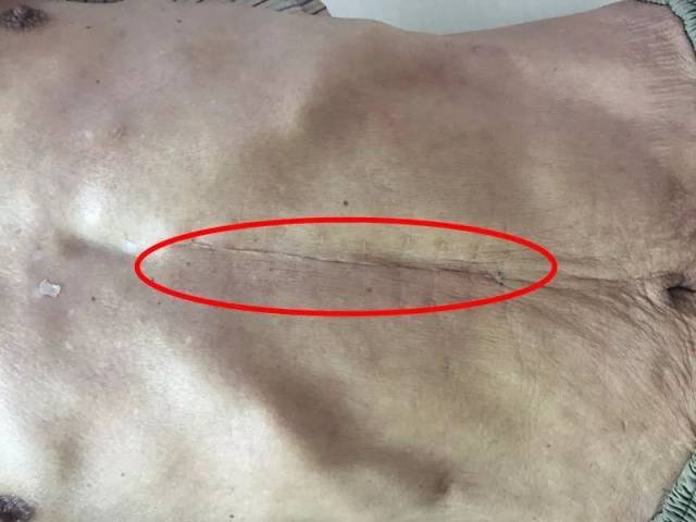 胃癌手术刀疤图片图片