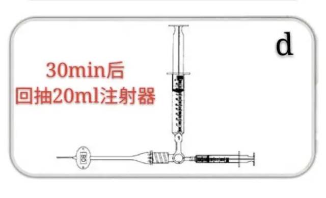 鞘内注射缩写图片