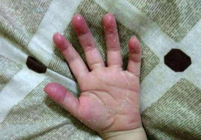 儿童十个手指头脱皮图片