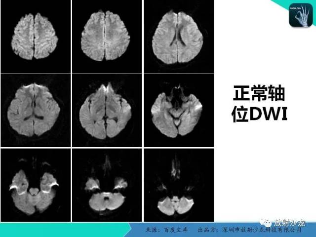 頭顱mri入門必修之讀片知識