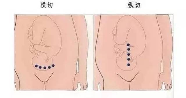 怀孕发烧,想第三次剖腹产,陈大夫告诉你该咋办