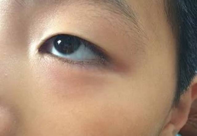 一般来说,眼睛巩膜发蓝是正常的,如果宝宝没有贫血的问题,都是没有