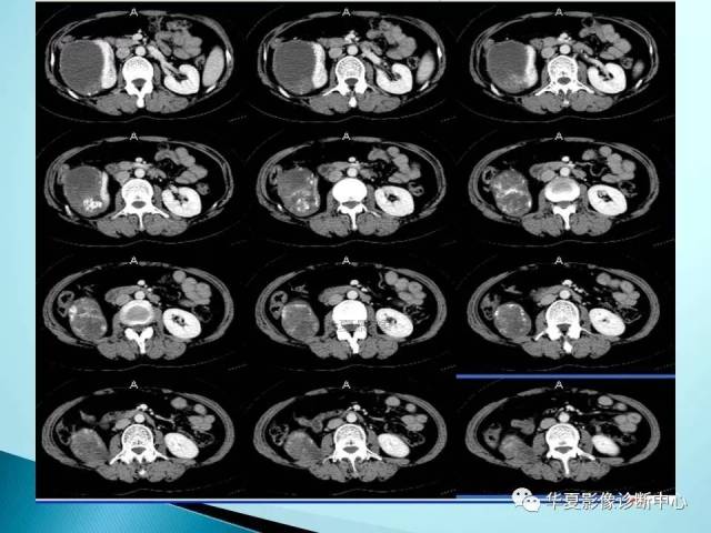 肾结核与囊性肾癌!你会鉴别吗?