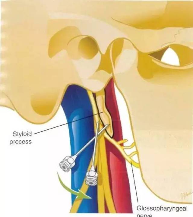 舌咽神经阻滞图片