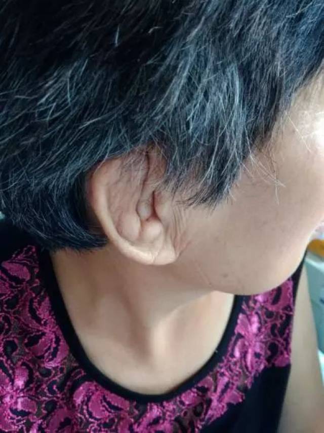 女子突现"菜花耳",原是复发性多软骨炎在作怪