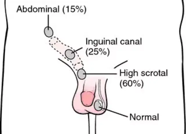 男人隐睾症的真实图片图片