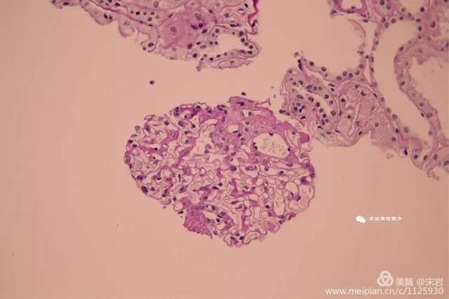 4个小纤维性新月体,1个小细胞纤维性新月体形成,余小球系膜细胞和基质