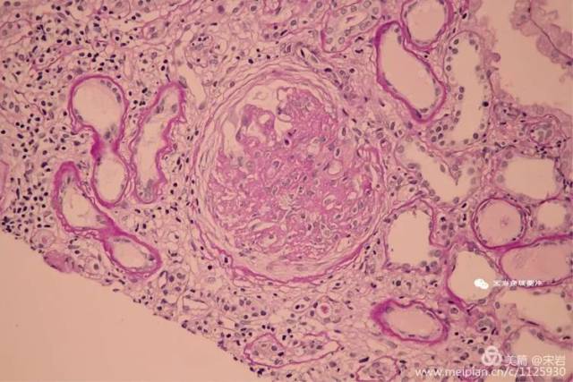 1个小细胞纤维性新月体形成,余小球系膜细胞和基质轻度弥漫性增生,系