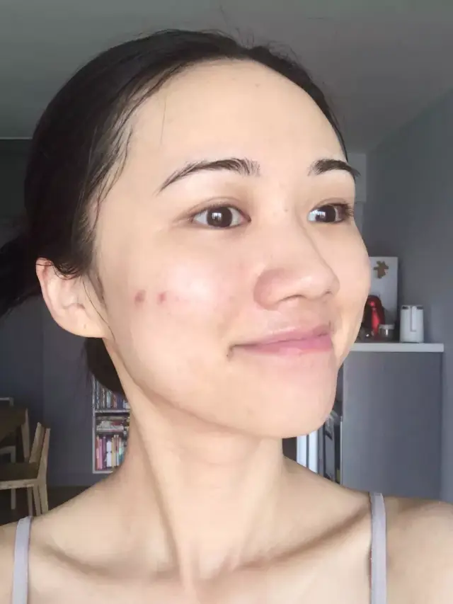 超强精油急救攻略,平价又有效,拯救痘痘脸,熬夜黄脸