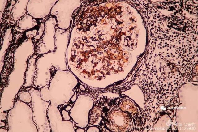 一起学病例 纤维样肾小球病