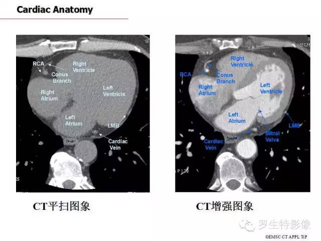 心脏CT横断面解剖图图片