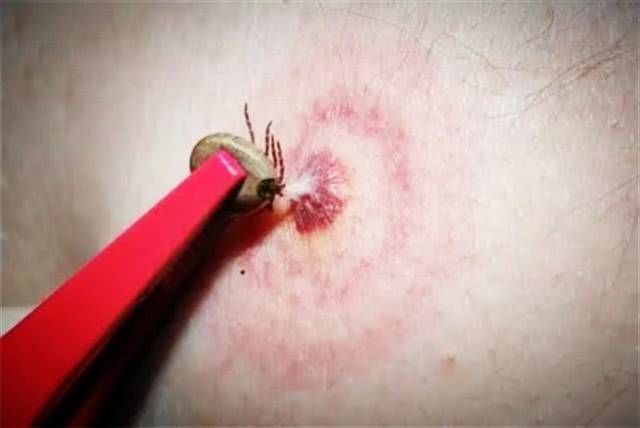 50年来美国首次出现新蜱虫外来物种会咬人但暂未发现携带病毒