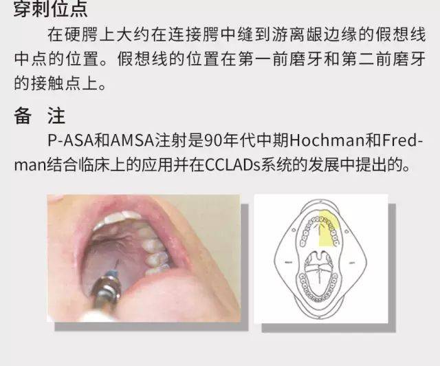 【临床技能】口腔局部麻醉技术(多图)