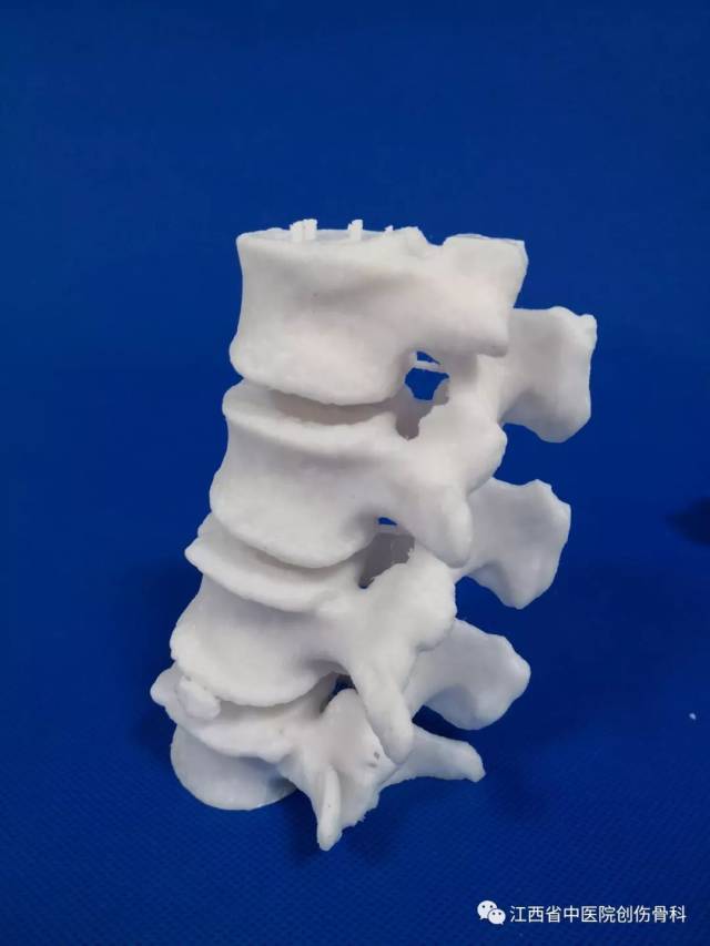 3d打印骨科应用 3d打印骨骼模型 3d打印假体植入物 3d导航模板 3d
