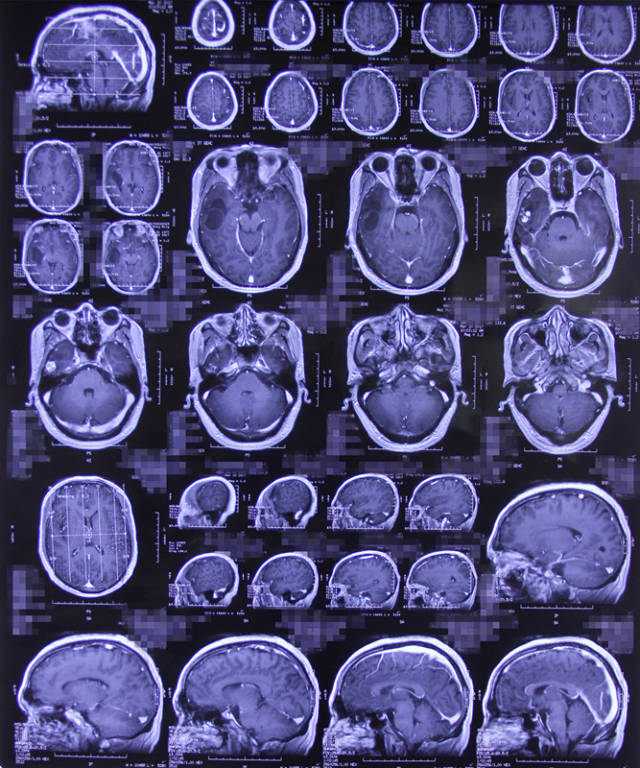 病例:手术切除罕见颅内血管周细胞瘤