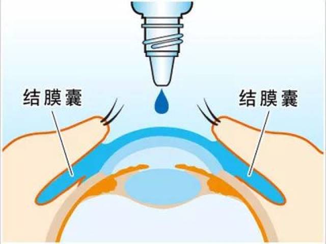 结膜囊是哪个位置图图片