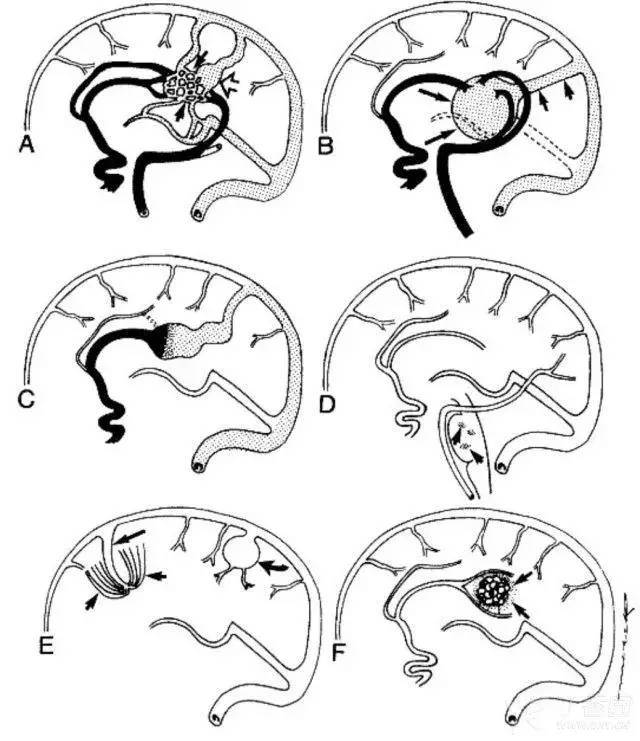 先來看看各種血管畸形的示意圖