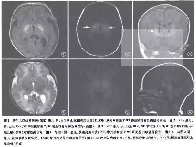 新生兒高膽紅素血癥及膽紅素腦病文獻複習與mri診斷