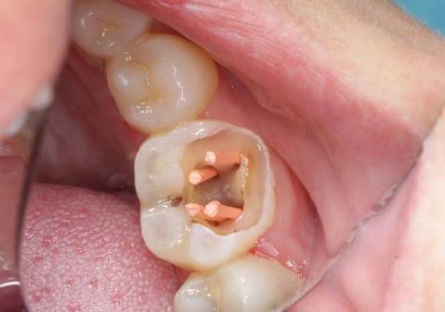 根管治疗全过程是怎么样的?,杀牙神经