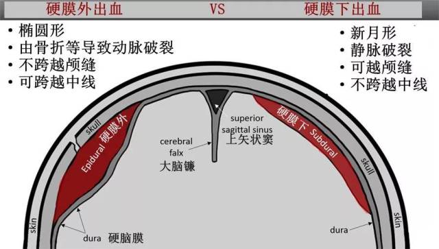 4 该患者具有急性和慢性硬膜下出血的特征