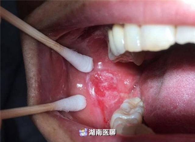 女子口腔溃疡1年多也未愈口腔溃疡和癌性溃疡傻傻分不清楚