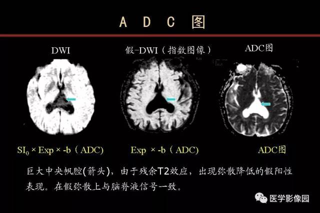 脑肿瘤的mr dwi和dti诊断和鉴别诊断(一) | 影像天地