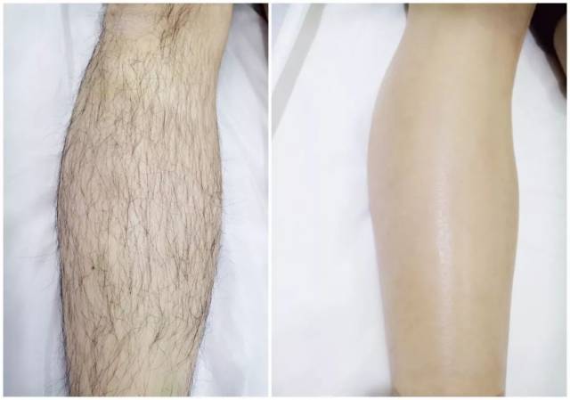 这个脱毛妙招你get了吗?