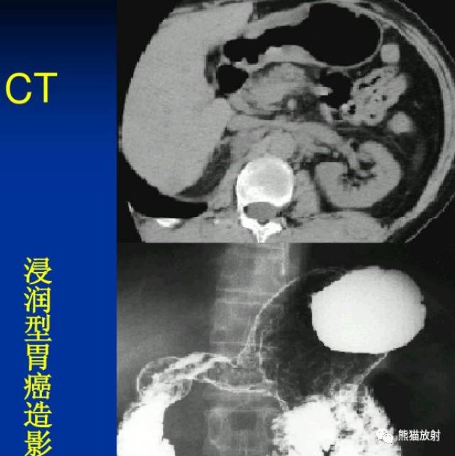 x線診斷要點丨胃腫瘤的那些概念和徵象