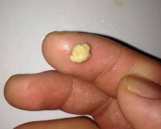 这种白色的小颗粒叫做扁桃体结石,是扁桃体上的穴口上出现的小小的