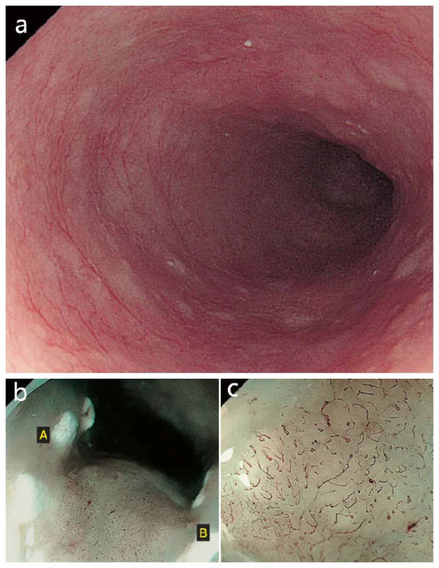 早期食管癌 内镜错误评估病例