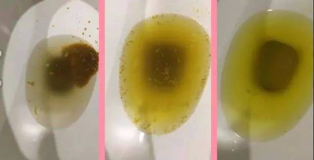 肠镜清肠 黄水图片