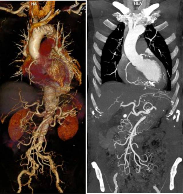 【重要消息】德国西门子双源ct落户临河人民医院,刷新你对ct的认知