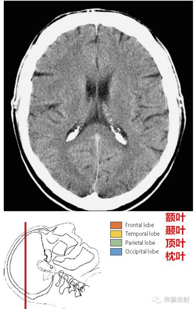 【解剖入门】颅脑ct断层(中英文对照)