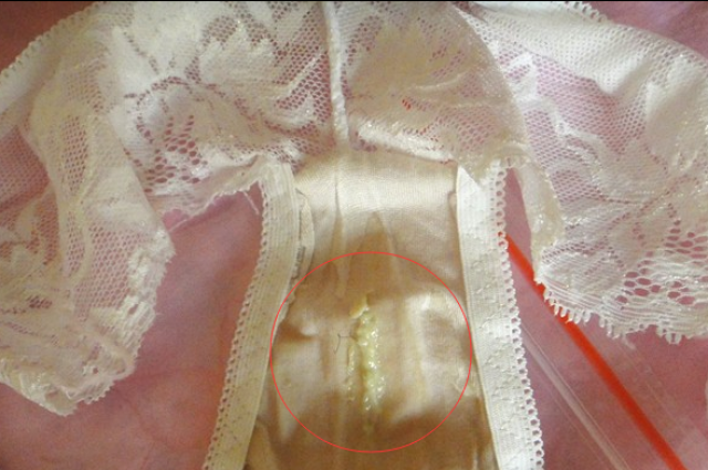 宫颈黏液脓性分泌物图片