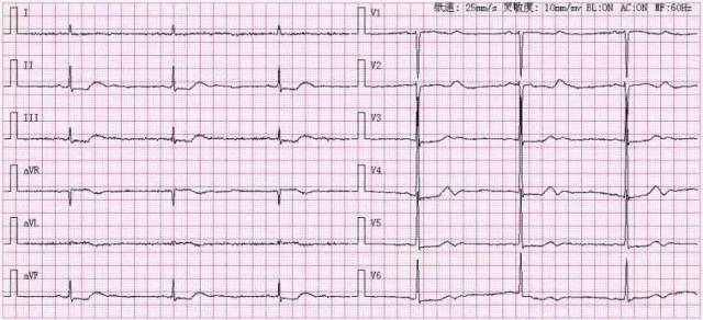 如何读懂心电图危急值?