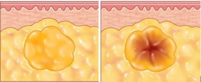 脂肪多隧道移植.