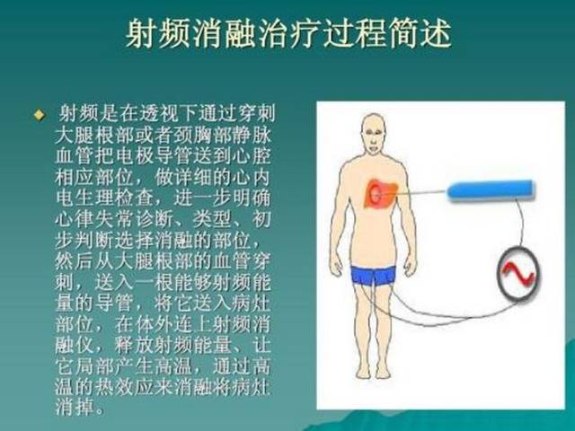 射频消融技术开始普惠我国骨肿瘤患者