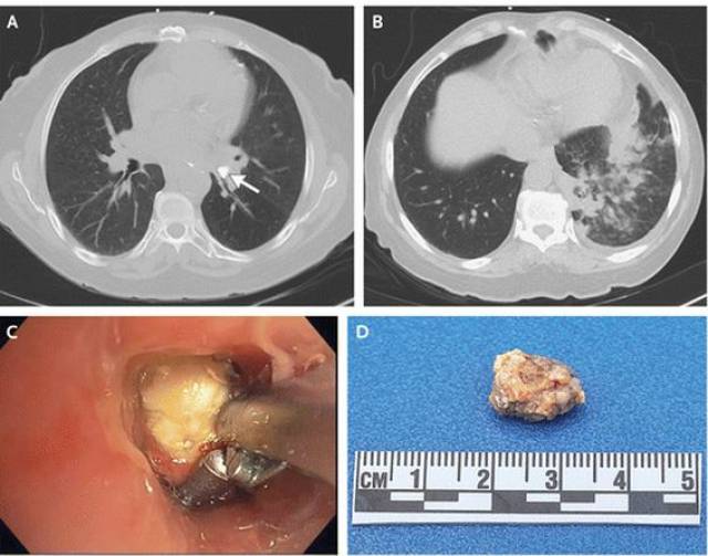 支气管结石,你见过吗?