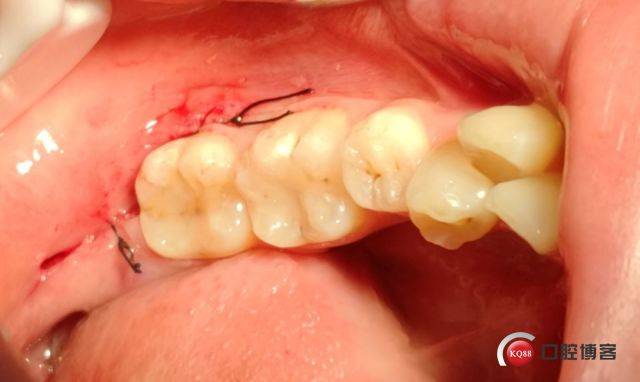 右下中位水平阻生智齿拔除