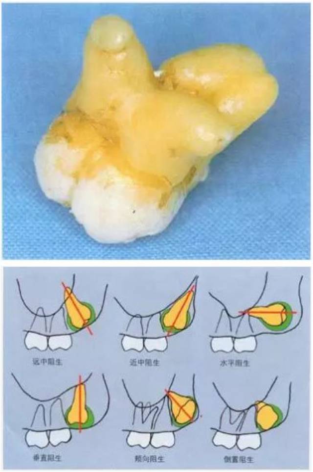 上頜第三磨牙:檢查與拔除