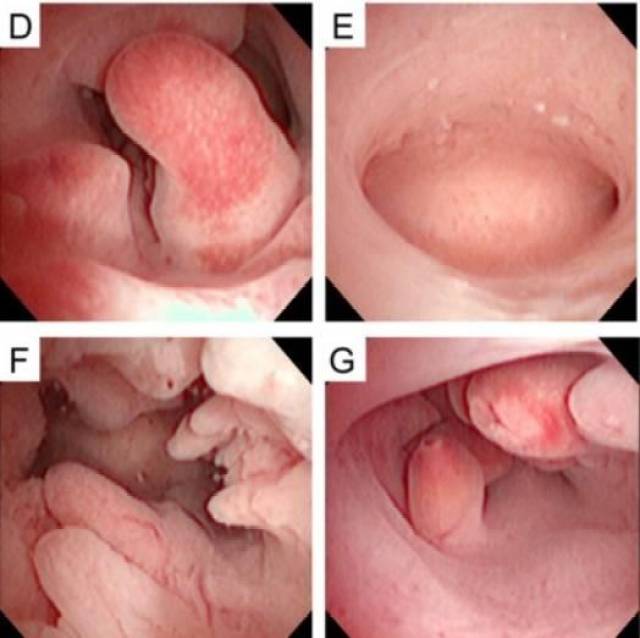 子宮內膜息肉——試管移植前一定要去除嗎?