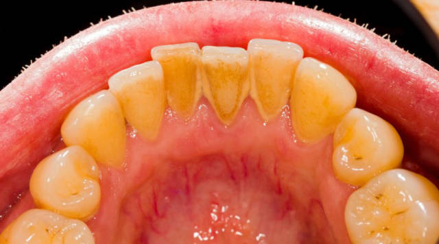 什么是牙垢和牙结石?