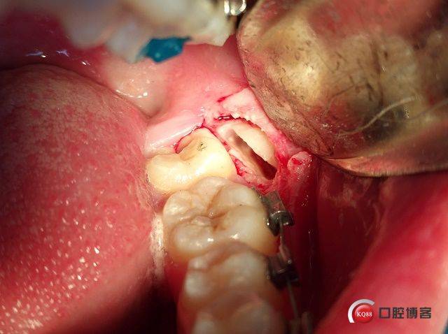 Ⅲ类低位近中颊侧水平埋伏阻生拔除术