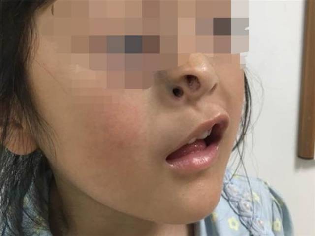 6岁女孩先天疾病长3个鼻孔 四川医生巧手重塑鼻子