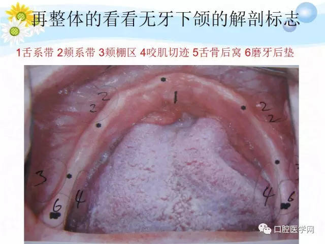 无牙颌的分区图片