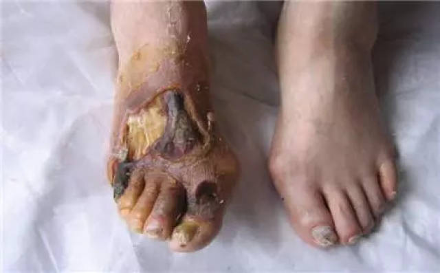 【介入科】下肢动脉硬化闭塞症三个关键字:疼,麻,凉