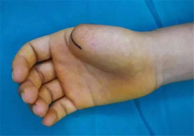 城事丨郴州男子大拇指被锯断17年,医生用脚趾为其再造拇指,能点赞!