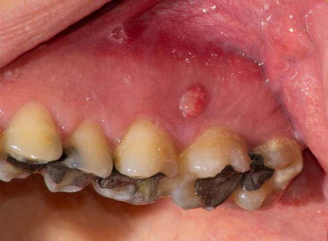牙龈肿胀隆起有脓图片图片